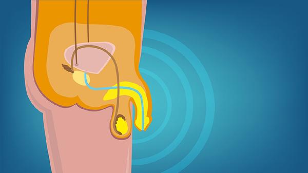 陽痿與早泄的區(qū)別