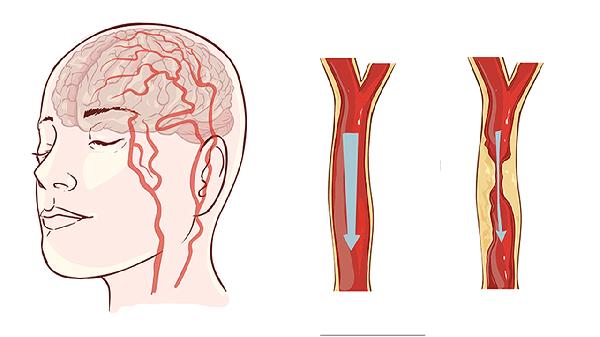 腦癌死前兩三天的癥狀有哪些