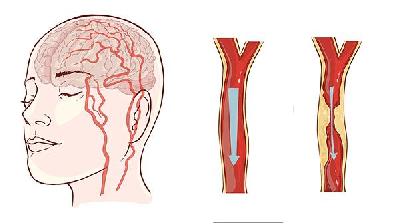 脑癌死前两三天的症状有哪些