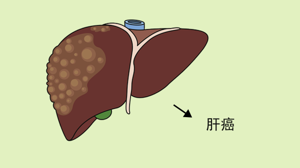 预防肝癌的中医养生智慧