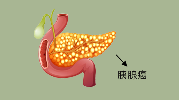 胰腺癌感染嗎？