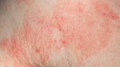 重癥藥疹都有哪些癥狀