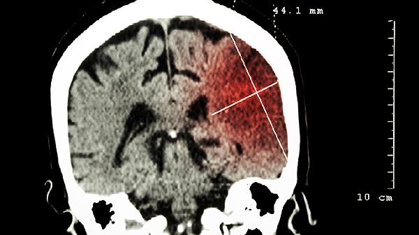 惡性腦瘤能活多少時間