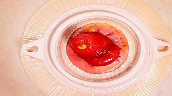 先天性食管裂孔疝手术能治好吗
