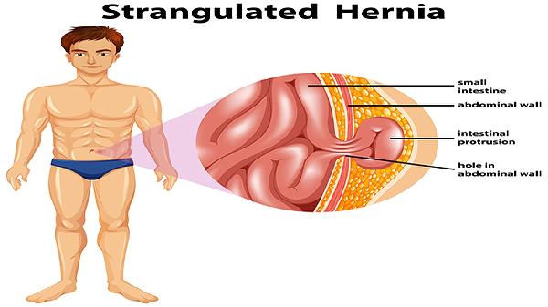 肠道健康的关键：厌氧菌如何影响你的消化与免疫力？