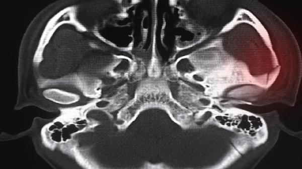 骨密度检查有辐射等于几次ct