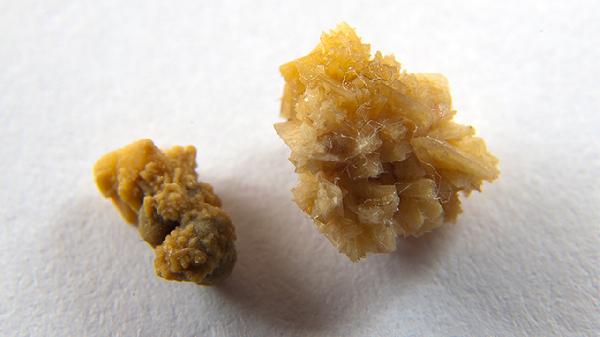 结石宝宝需要注意什么