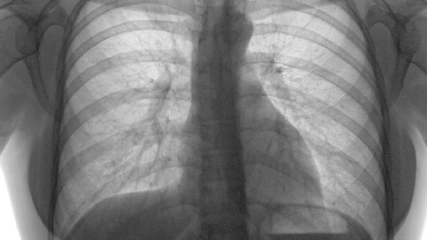 肺栓塞患者需要吃什么药