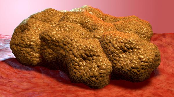 hpv16感染一年会癌变吗