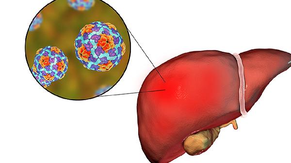 肝癌发烧是不是加重