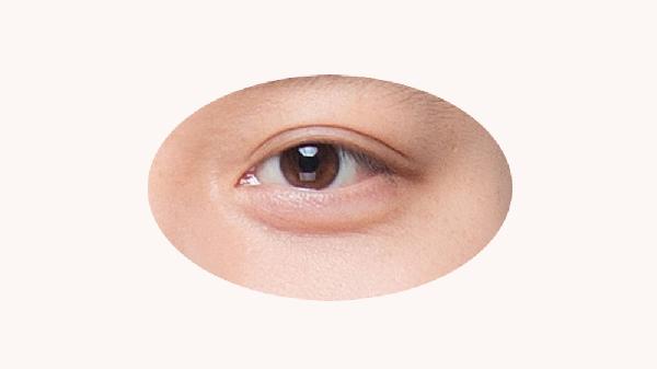 腫泡眼雙眼皮手術(shù)有哪些后遺癥？