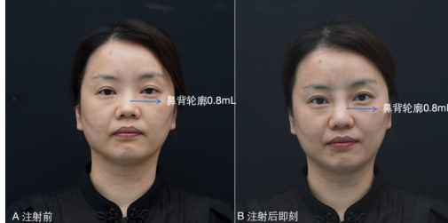 再生胶原界的“劳斯莱斯”贝丽菲尔，海峡整形全省耀世首发