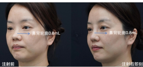 再生胶原界的“劳斯莱斯”贝丽菲尔，海峡整形全省耀世首发
