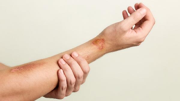 吃了金刚藤排出大量瘀血