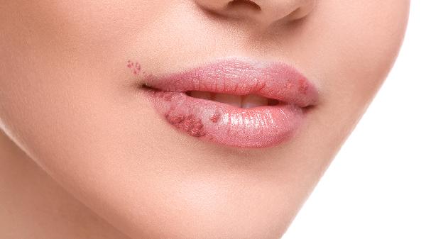 嘴唇起疱会传染吗