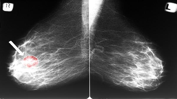 唯一不影响寿命的癌