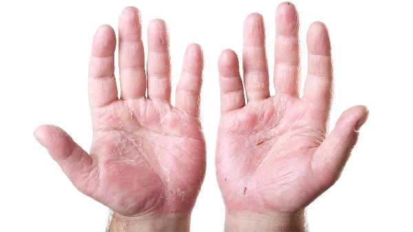 本人鹅掌风治好了