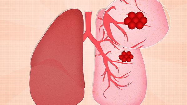 肺结节与肺结节影是一样吗