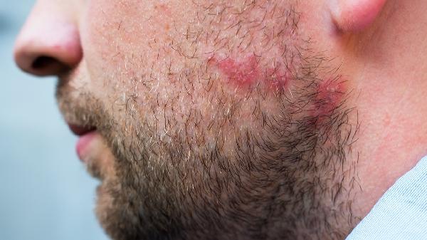 身上全是毛囊炎怎么办