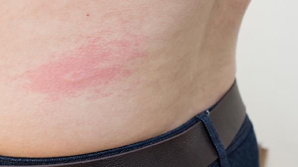 体癣是严重的病吗