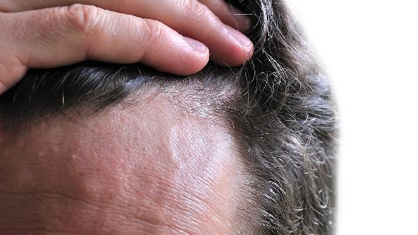 头虱会自己消失吗