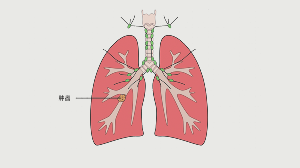 47岁大哥查出肺癌,从不抽烟,医生叹息:这3件事还有人天天做