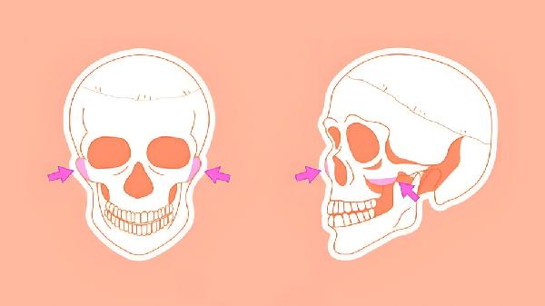 做3D颧骨旋转术副作用有哪些