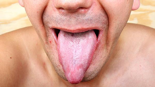 男人包头有溃疡是咋回事