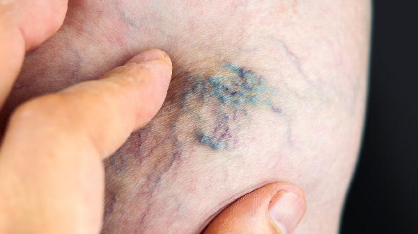 静脉曲张一二三级的区分