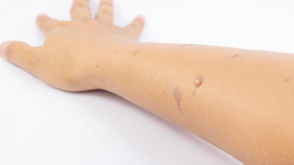 做完包皮手术后起水泡