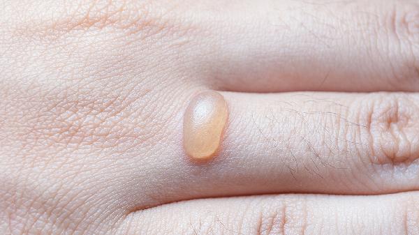 做完包皮手术后起水泡