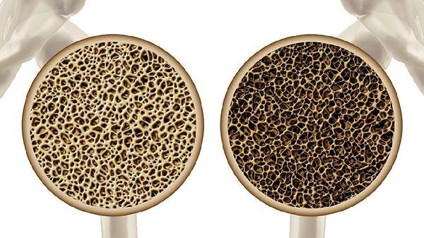 骨骼闭合如何二次刺激长高