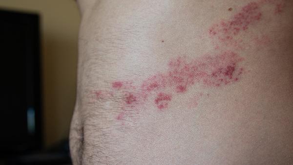 解决皮肤粗糙的方法有哪些