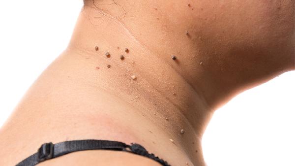 天生皮肤粗糙怎么改善