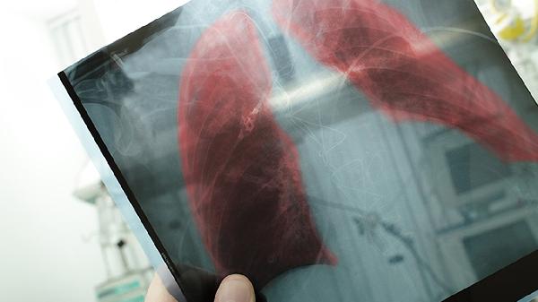 肺不好不能吃鱼肉？告诫：避免肺病发展成肺癌，3物最好都要少吃