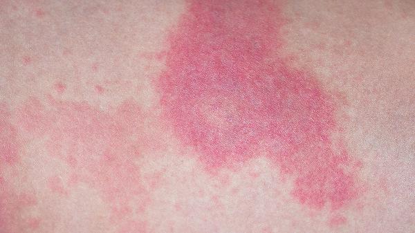 宝宝体癣是怎么引起的 三种病菌会诱发宝宝体癣