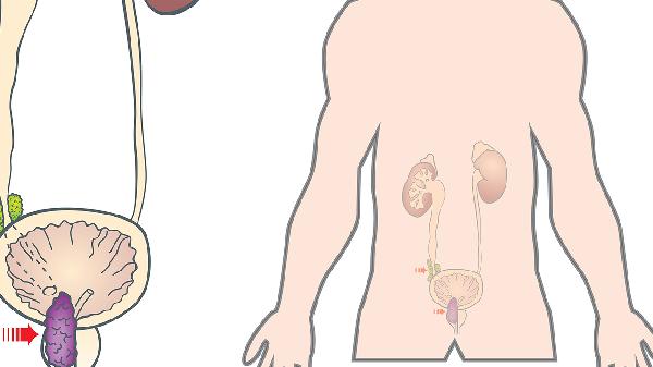 腎結(jié)石手術(shù)后如何正確護(hù)理