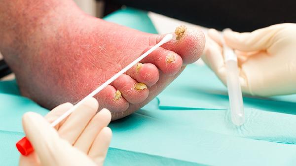 指甲刀會(huì)傳染腳氣嗎