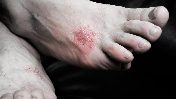 中医治疗银屑病效果怎么样