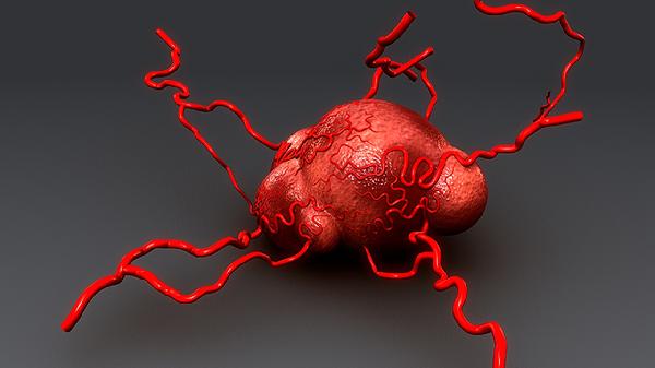 舌癌良性腫瘤與惡性腫瘤的區(qū)別