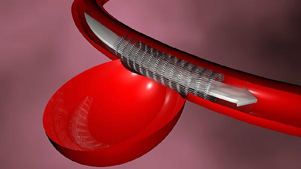 老人脑血管动脉瘤破裂