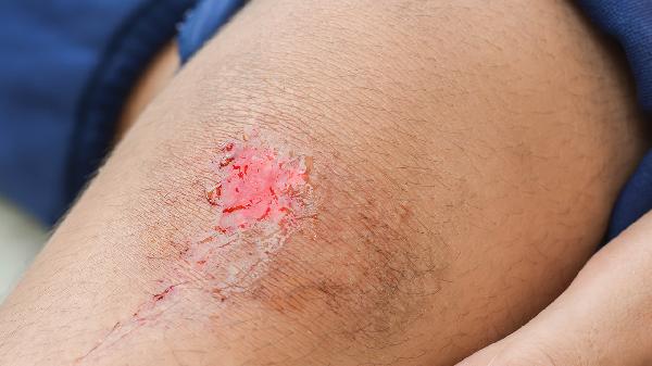 伤口不容易愈合是什么原因