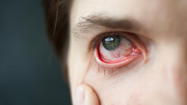 结膜炎冲洗的方法有哪些 教你结膜炎的正确冲洗步骤