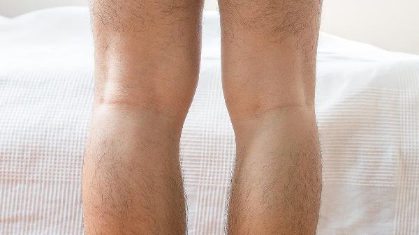 大腿内侧有红色印痕怎么去除