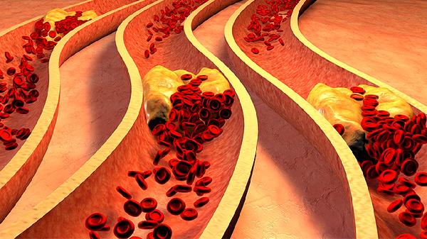 高脂血症会引起急性胰腺炎的原因