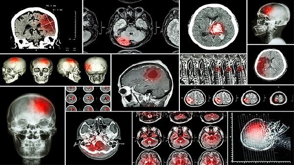 孩子小脑损伤的症状有哪些 孩子小脑损伤的4症状须知