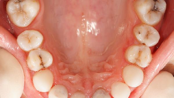 牙齿两边的肉肿起来怎么回事
