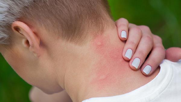 怎样才能治好皮肌炎 治好皮肌炎的3个方法盘点
