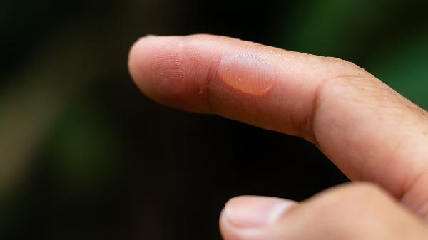 烫了水泡怎么处理 烫了水泡三个处理方法介绍