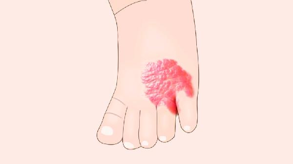 舌部血管瘤如何治疗